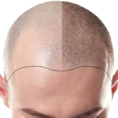 scalp density course