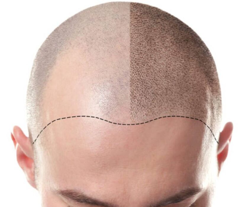 scalp density course